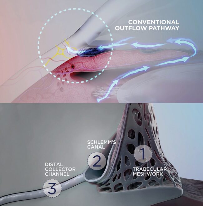 OMNI™ Surgical System - OMNI Surgical System | Sight Sciences